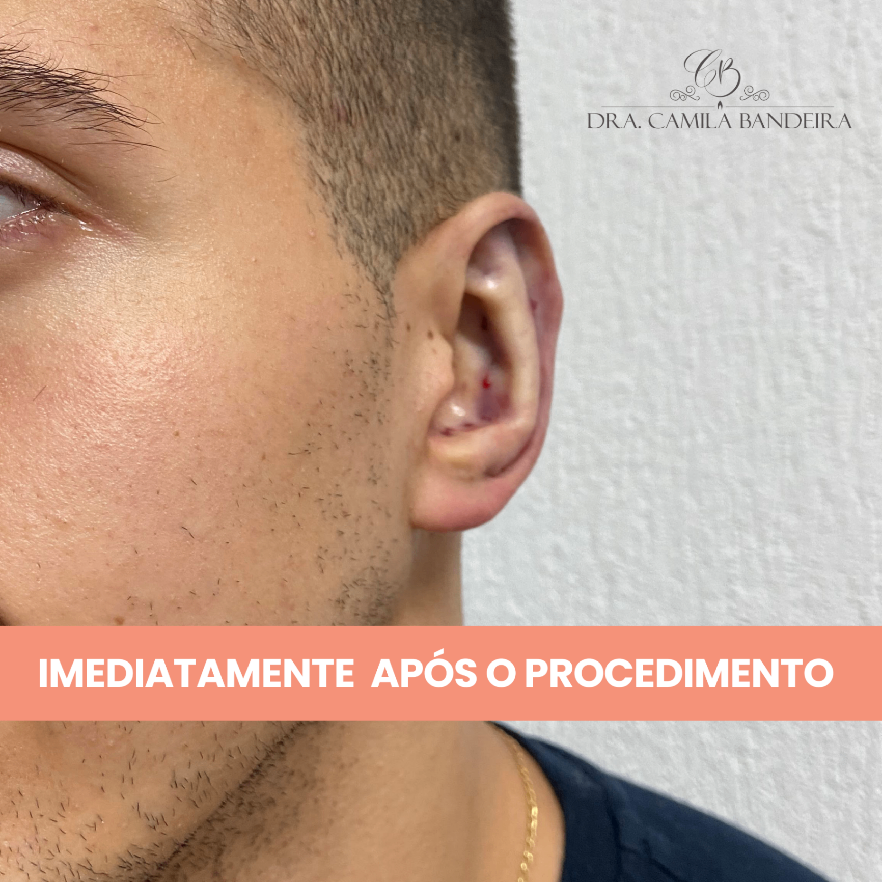 Etapa 2 do procedimento