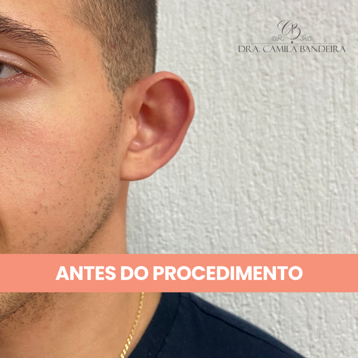Etapa 1 do procedimento